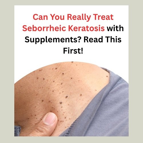 Can You Really Treat Seborrheic Keratosis